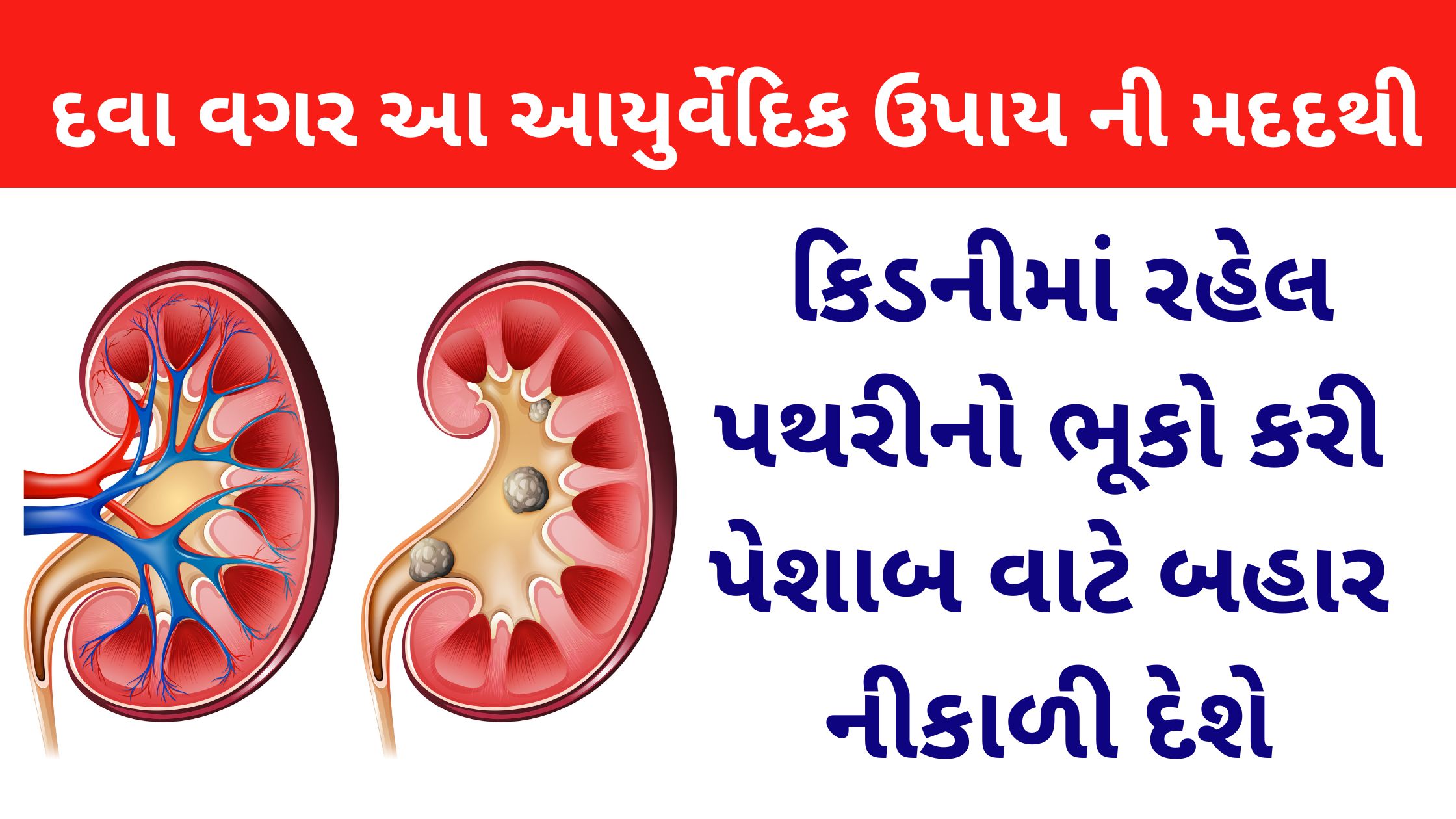 Ayurvedic Remedies for Kidney Stone